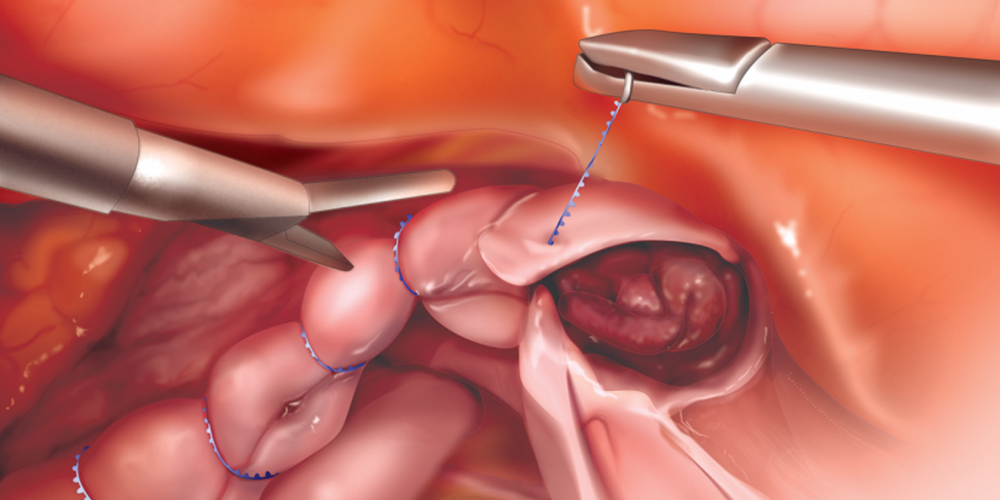 Lap Hysterectomy